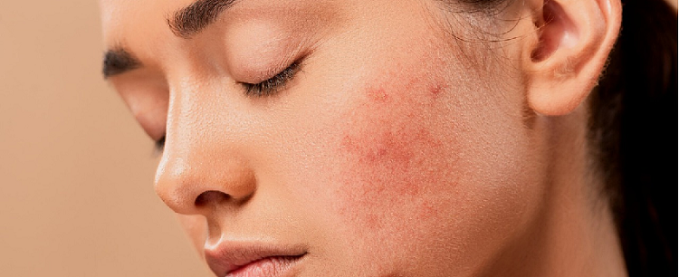 L'acne è un disturbo dalla pelle