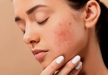Guida all'acne