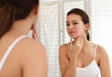 Come trattare le cicatrici da acne